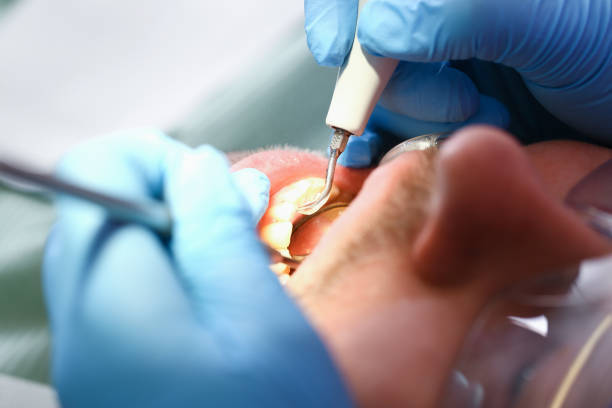 Best Emergency Tooth Extraction in Norwalk, OH